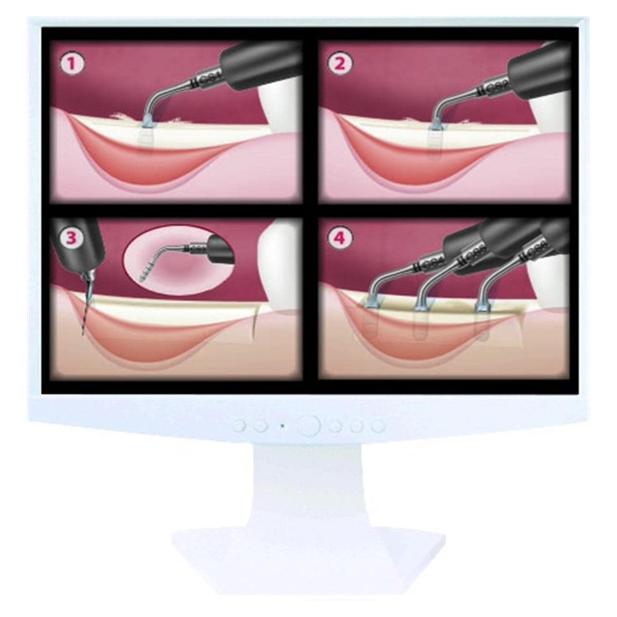 Kit Crest Splitting 2 ACTEON SATELEC