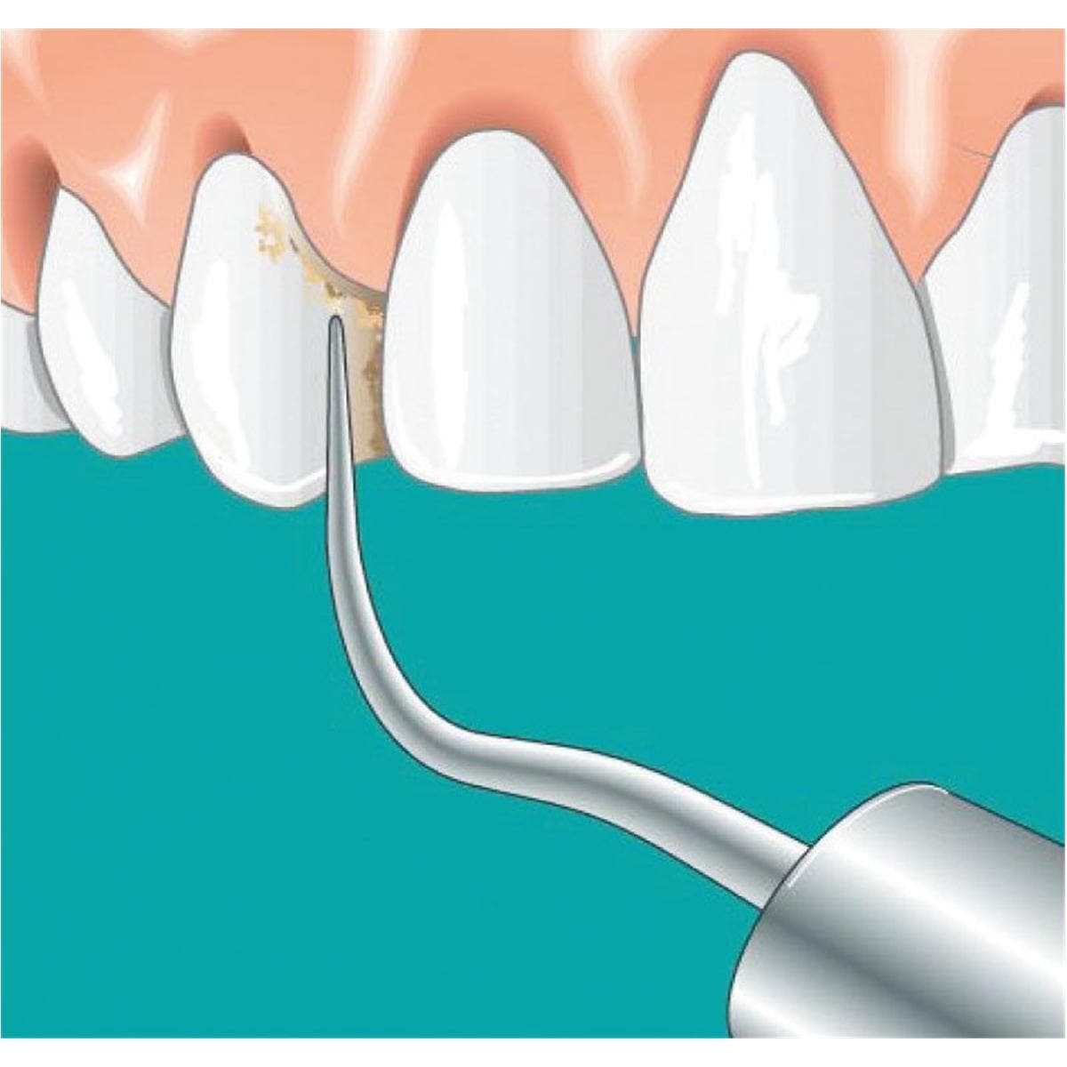 Insert SONICflex scaler n 6 KAVO