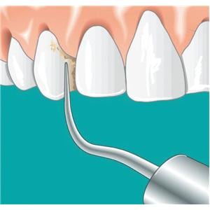 Insert SONICflex scaler n 6 KAVO