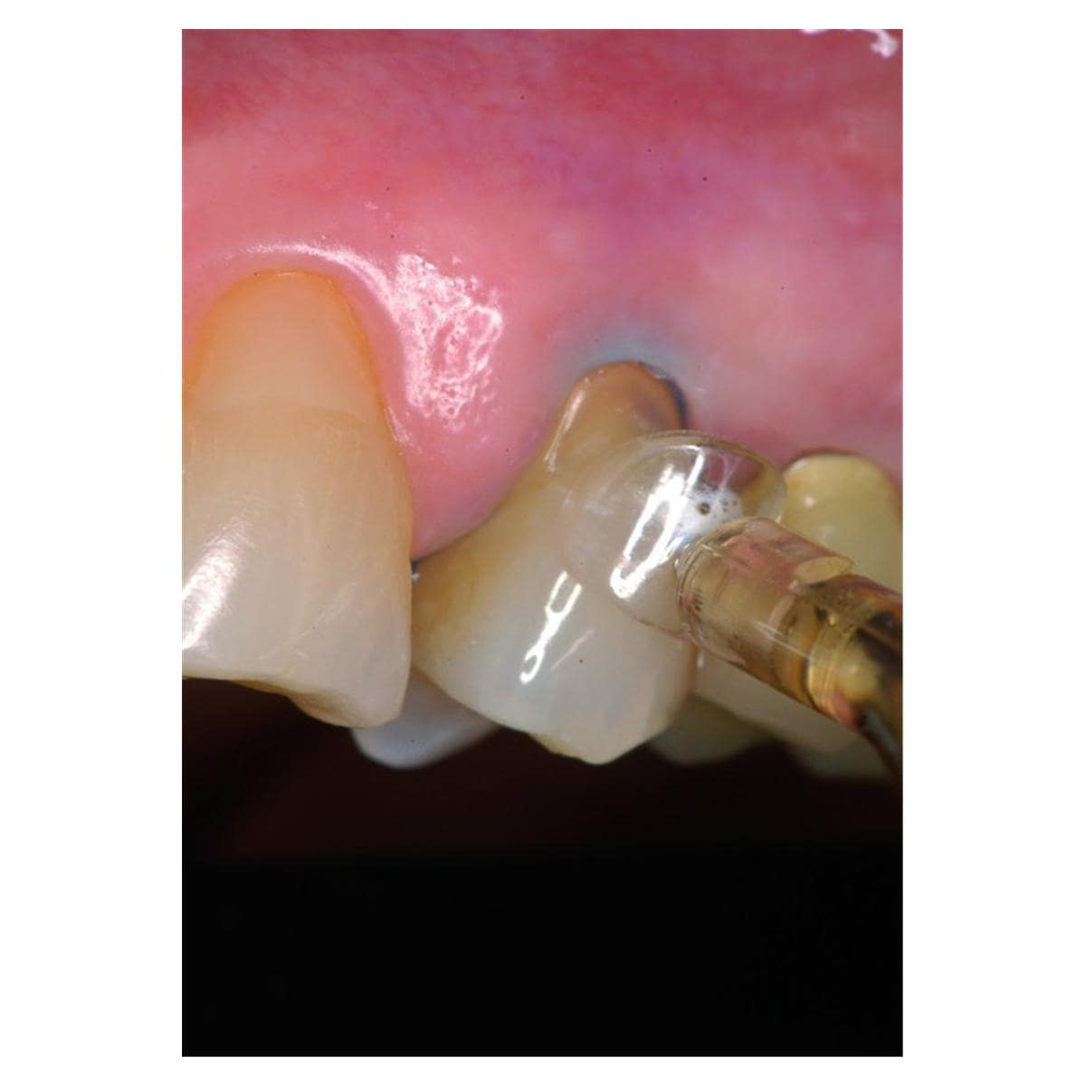 Matrices cervicales transparentes KERR - Coffret