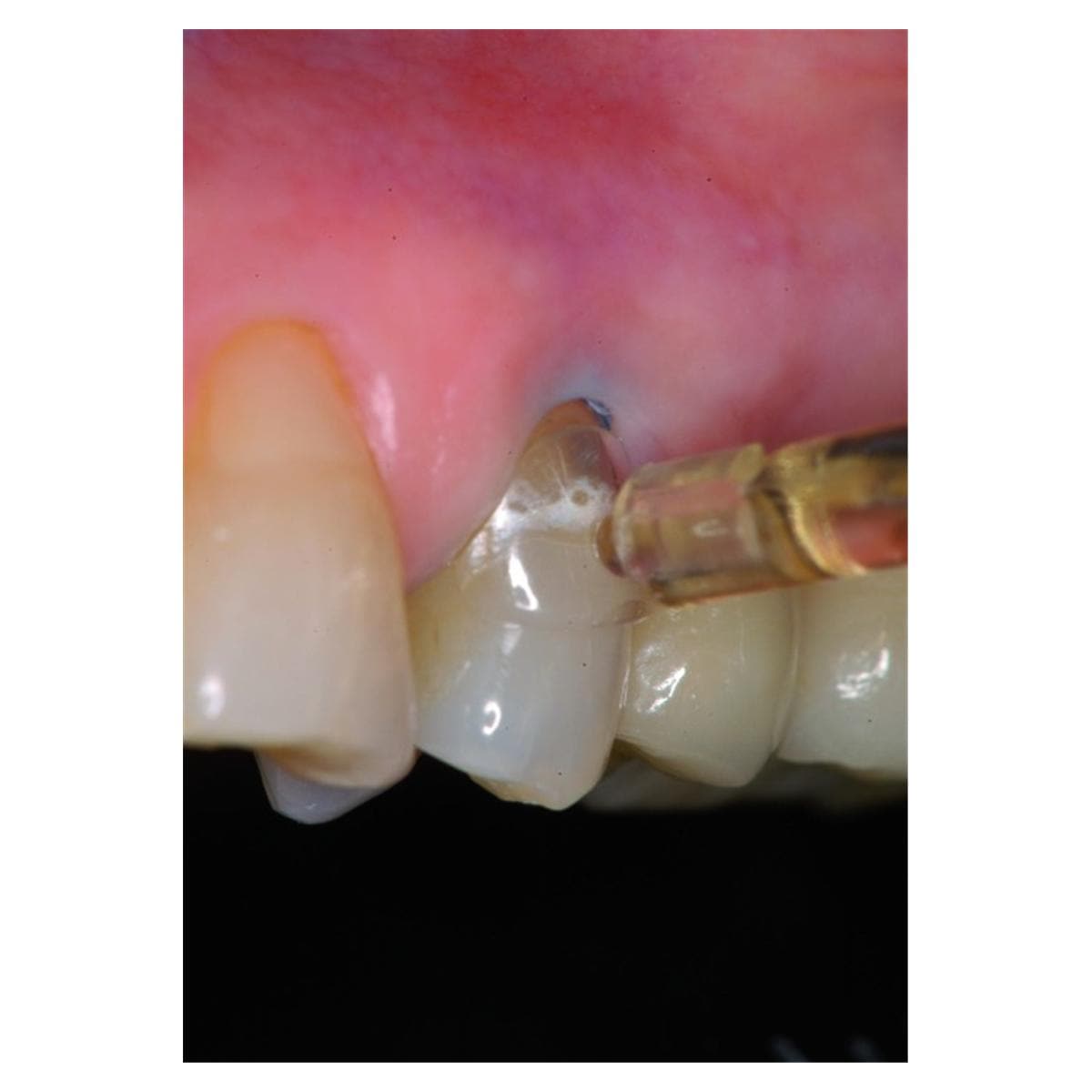 Matrices cervicales transparentes KERR - Coffret