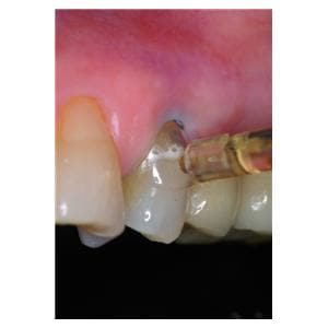 Matrices cervicales transparentes KERR - Coffret