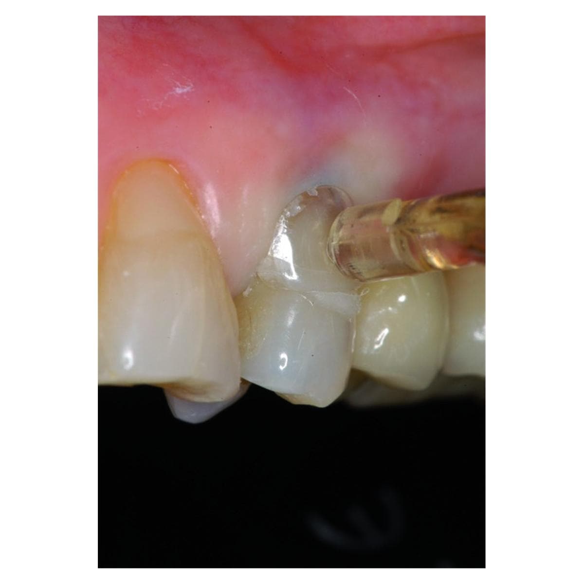 Matrices cervicales transparentes KERR - Coffret