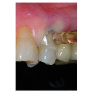 Matrices cervicales transparentes KERR - Coffret