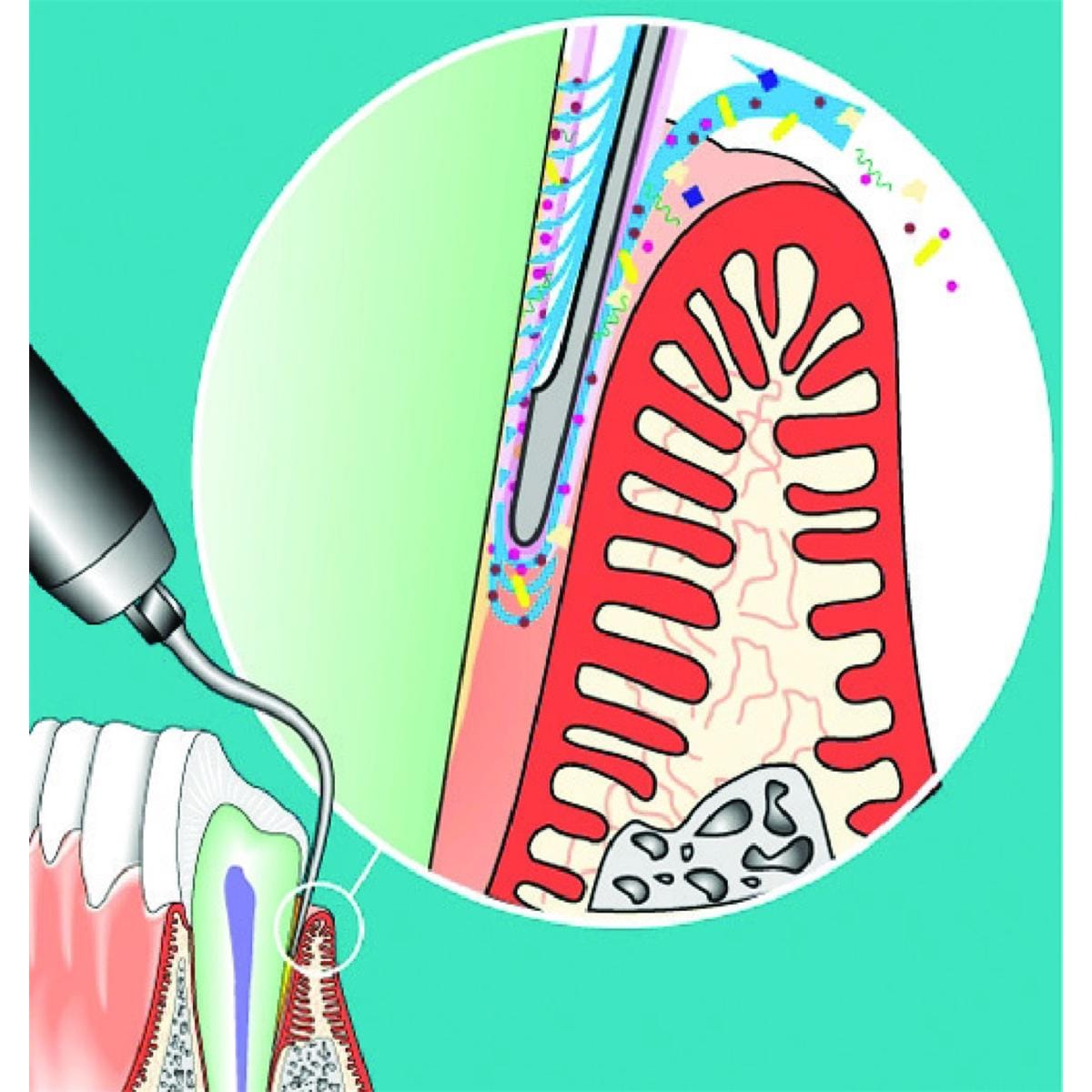 Insert SONICflex Paro n61 KAVO