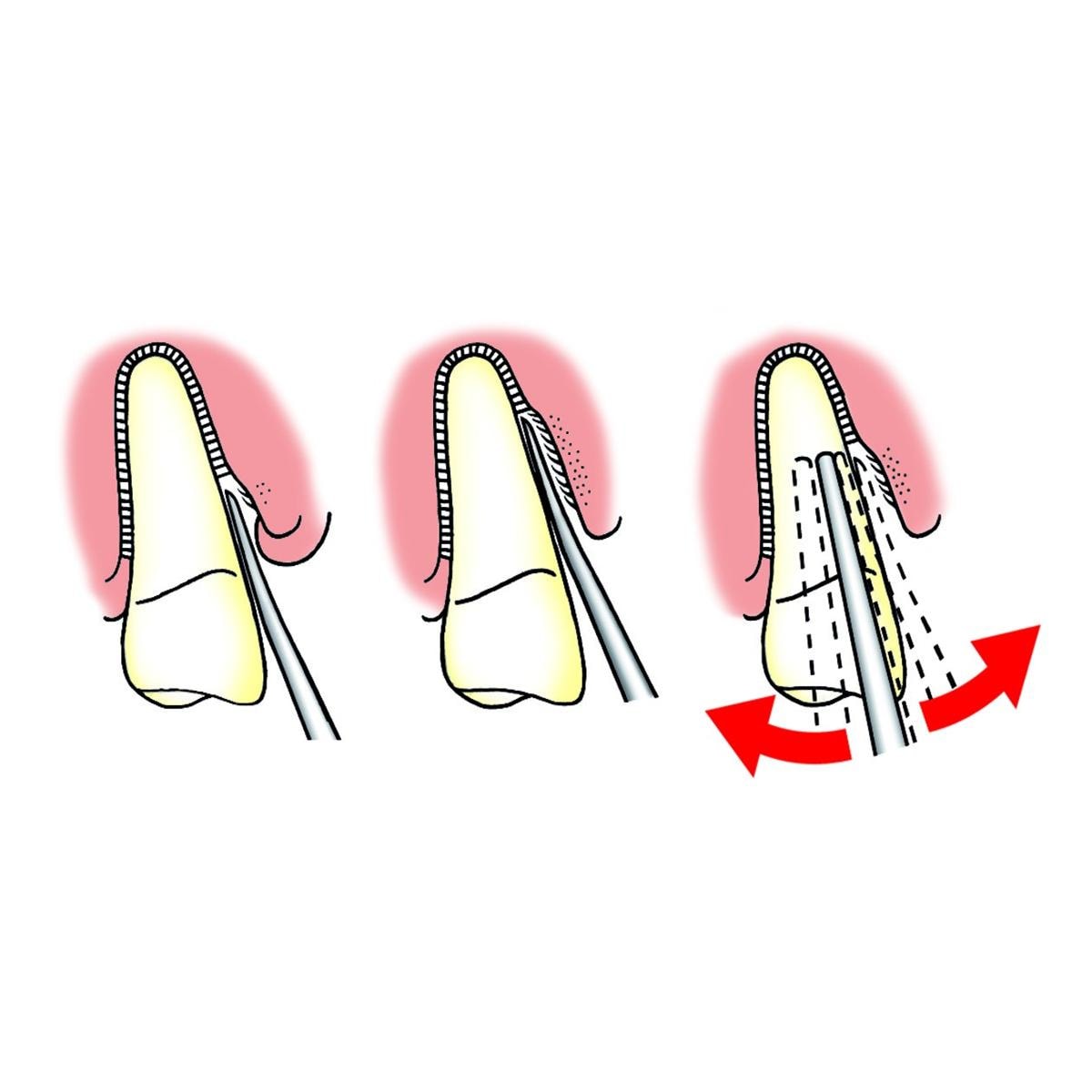 Luxator Periotome L3CA