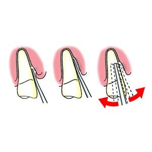 Luxator Periotome L3CA