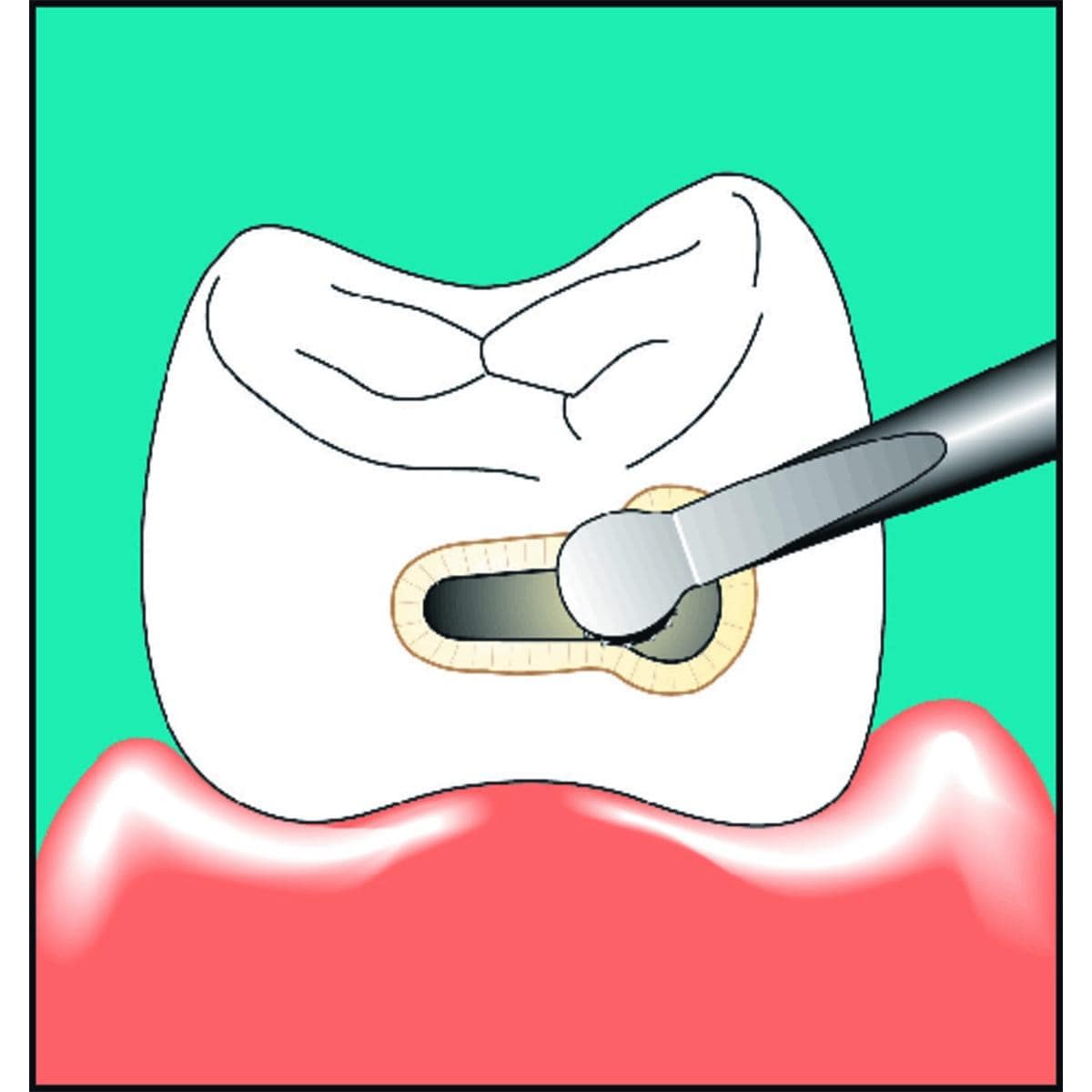 Insert SONICflex n59 KAVO