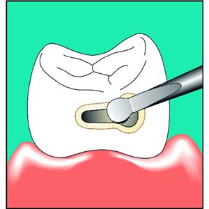 Insert SONICflex n59 KAVO