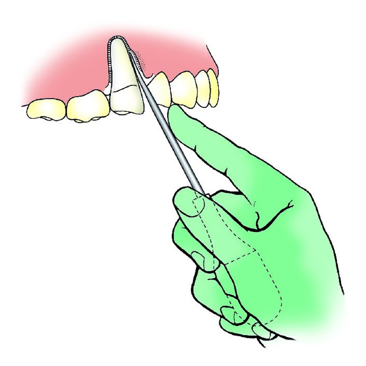 Luxator Periotome L3C
