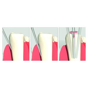 Luxator Periotome L2S