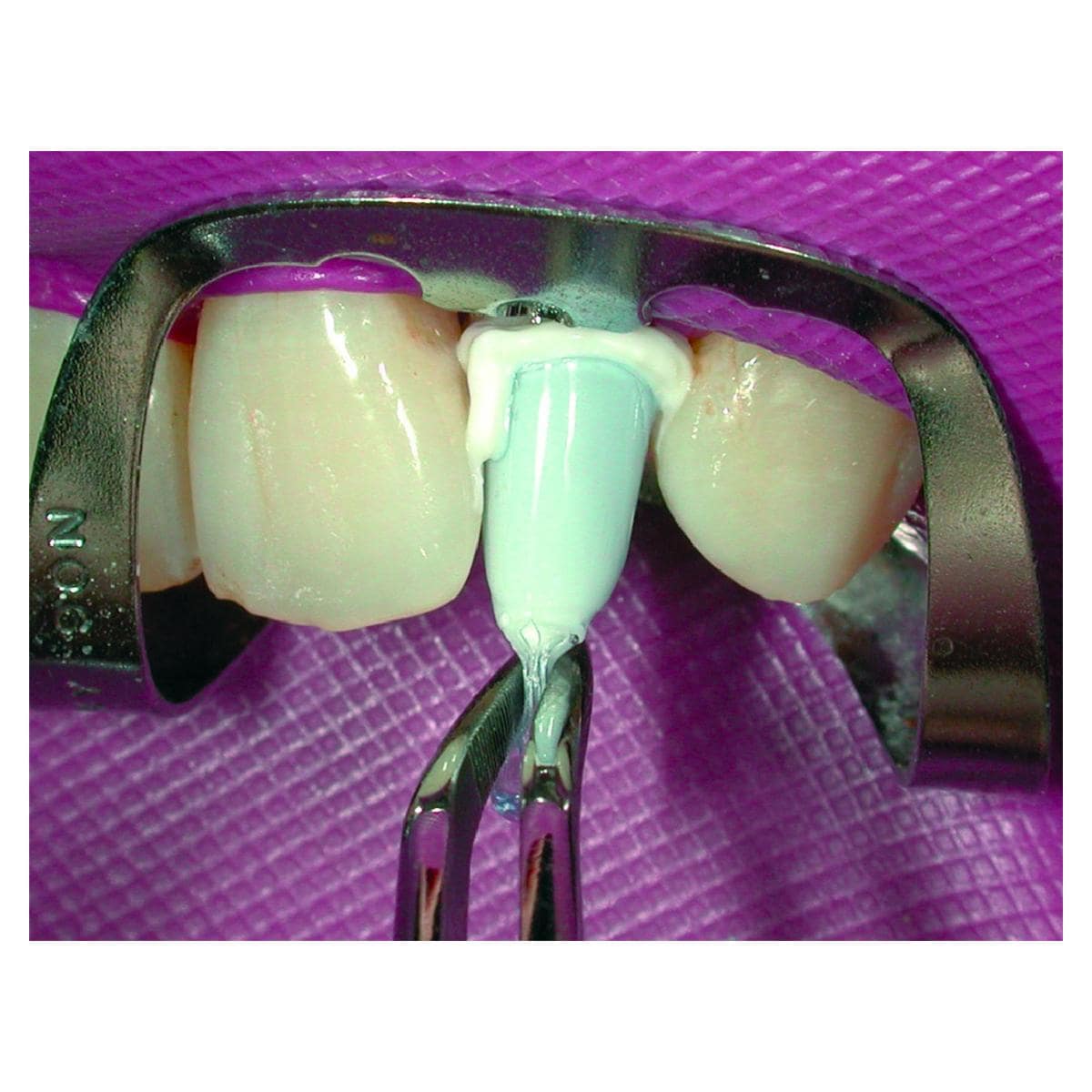 Paracore Automix COLTENE - Dentine - Coffret