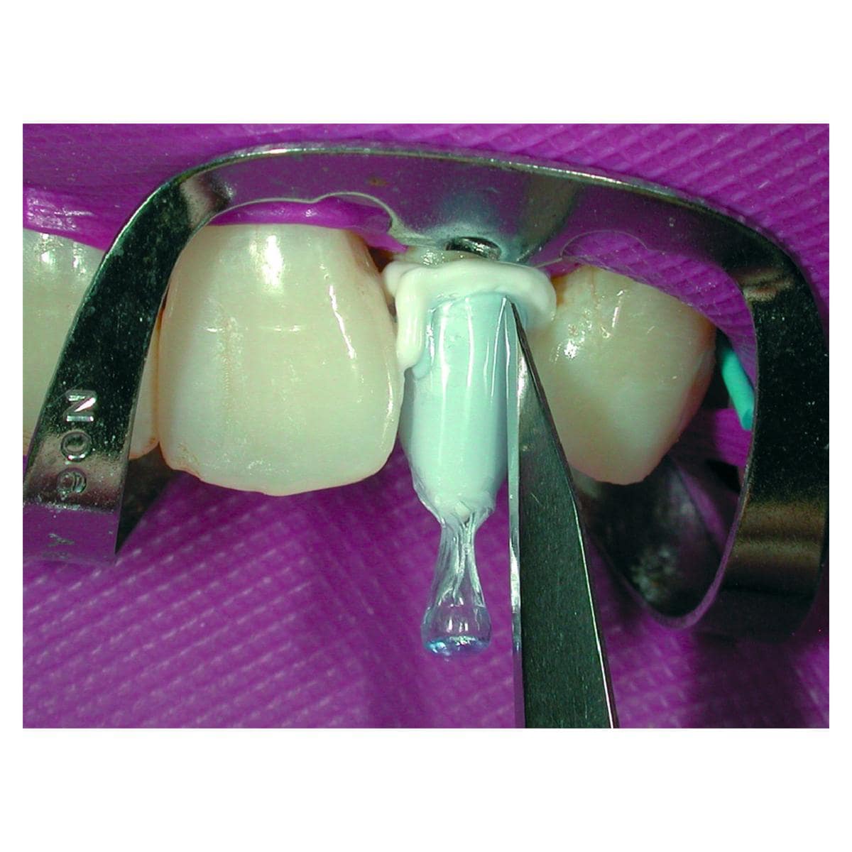 Paracore Automix COLTENE - Dentine - Coffret