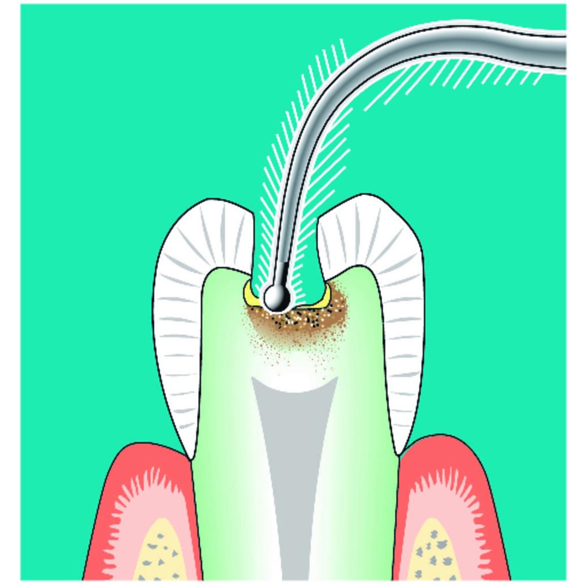 Insert SONICflex cariex nTC71 KAVO