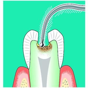 Insert SONICflex cariex nTC71 KAVO