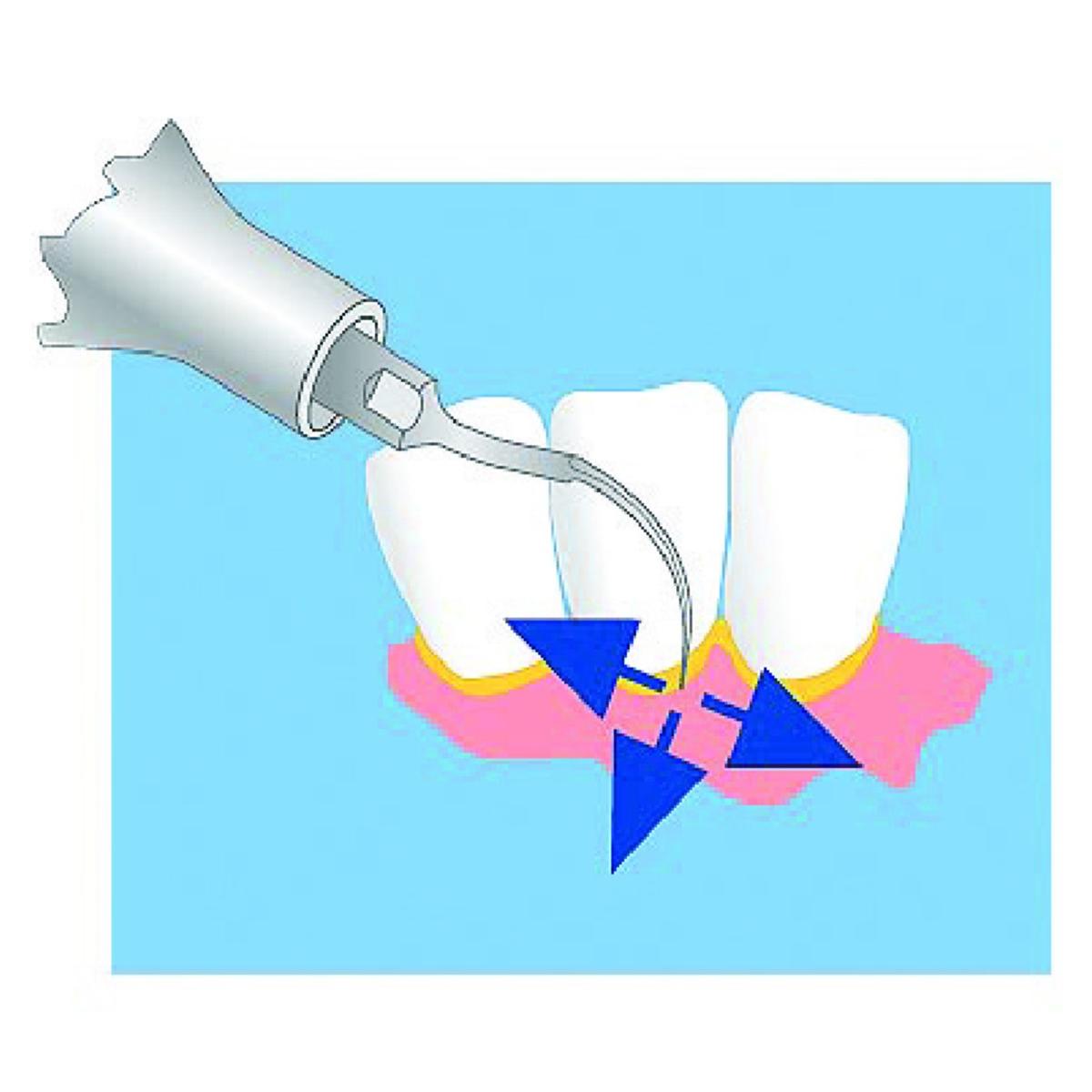 Insert de dtartrage S1 MECTRON