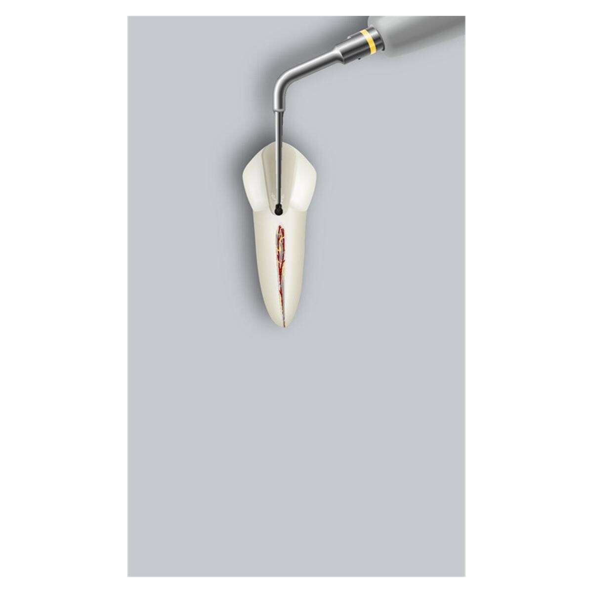 Insert Endo Success retraitement ETBD ACTEON SATELEC