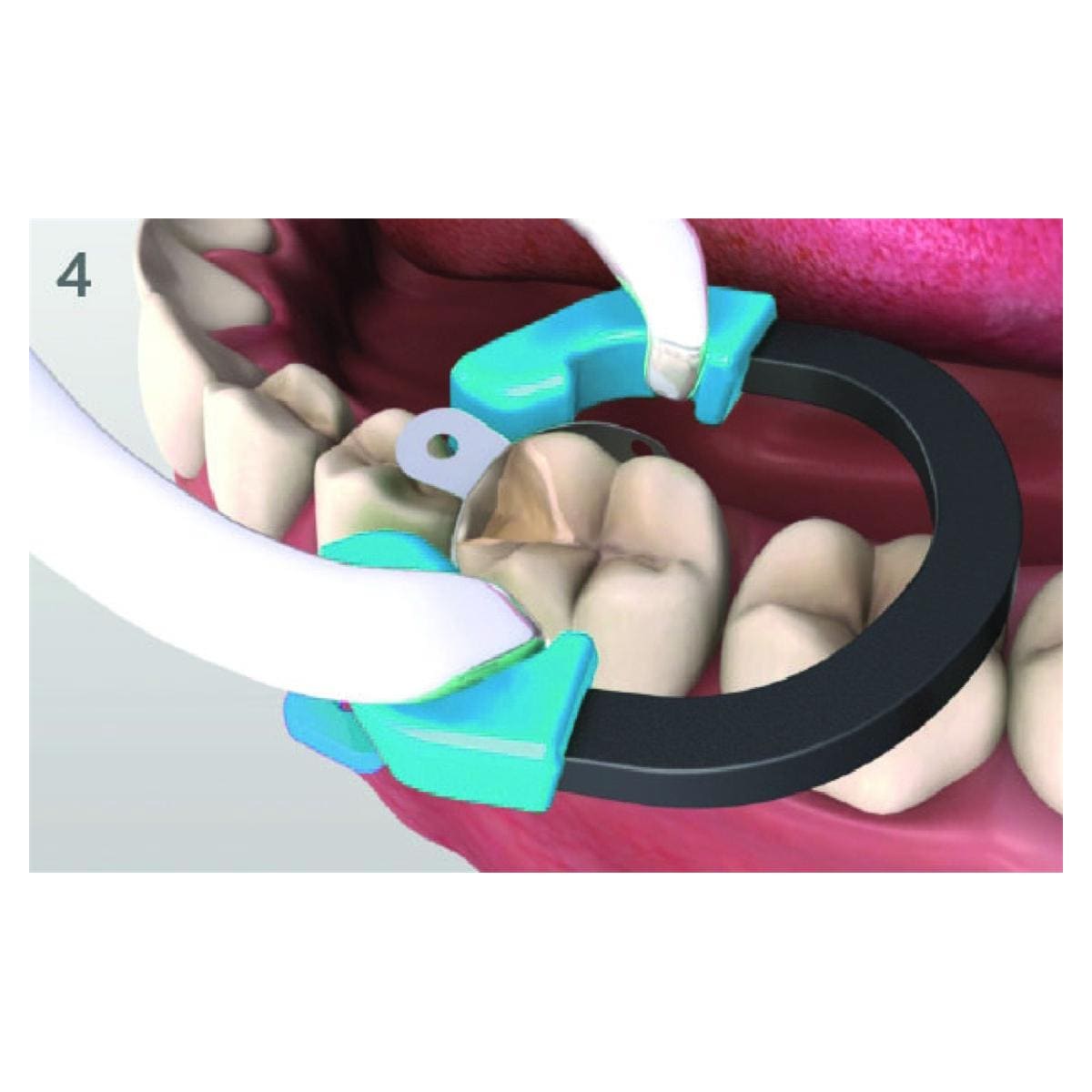 Palodent V3 Anneaux Universels 659760V Dentsply