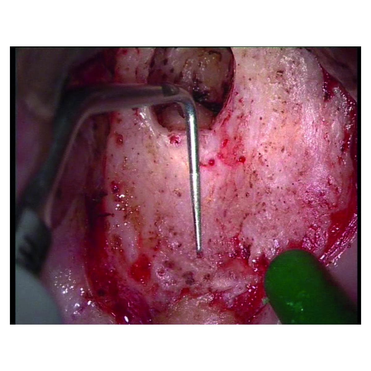 Insert Endo Success AS3D ACTEON SATELEC