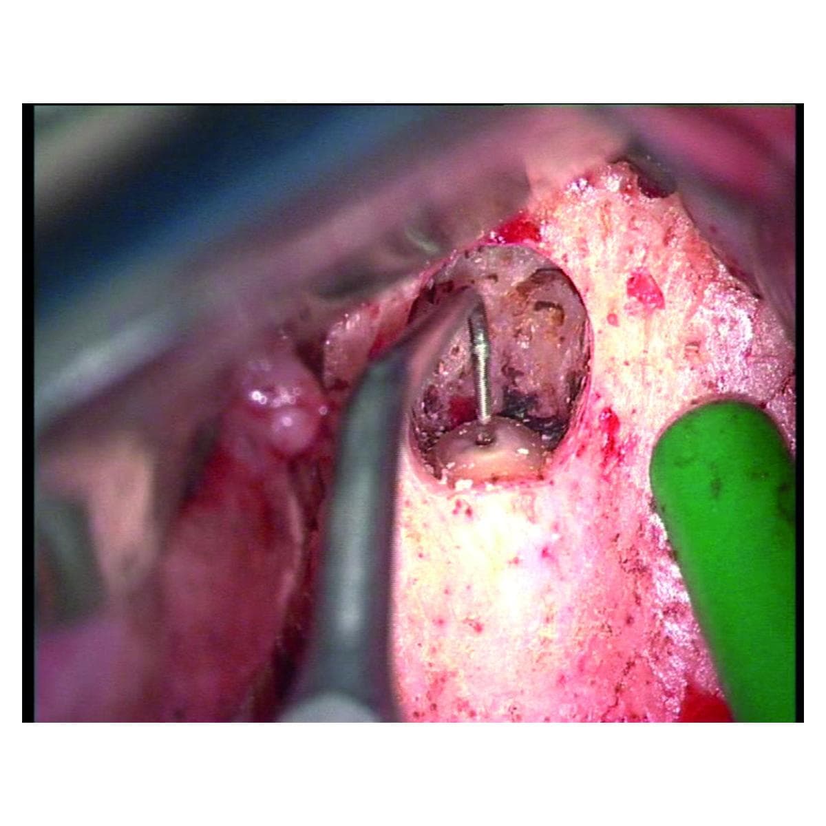 Insert Endo Success AS3D ACTEON SATELEC