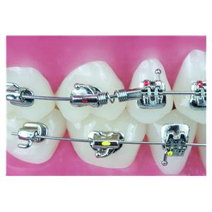 Ressort de distallisation TruFlex ORTHO-TECHNOLOGY - Lot de 3