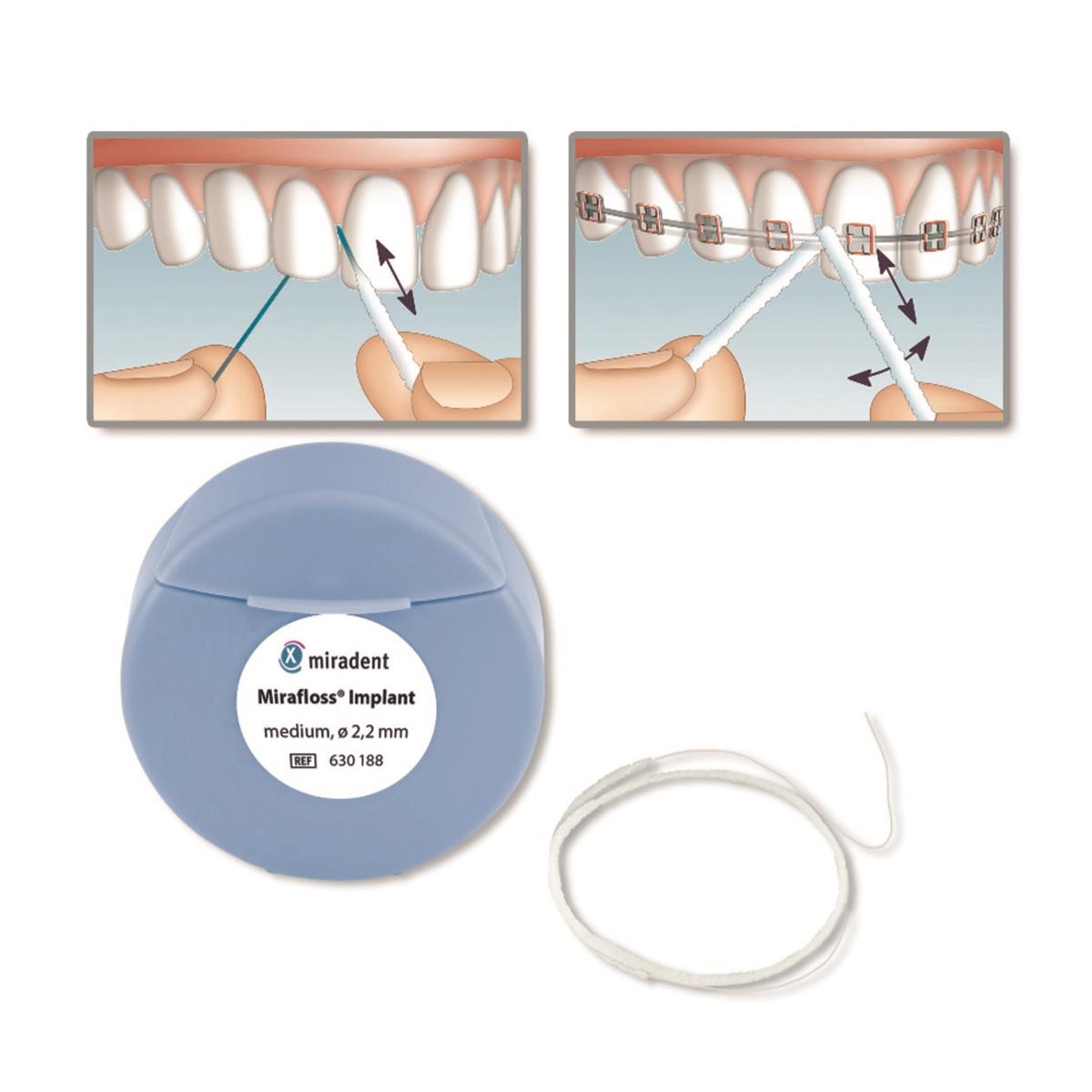 Fil de soie pour implant - Mirafloss - Implant - SDI - 2,2 mm - 1 rouleau
