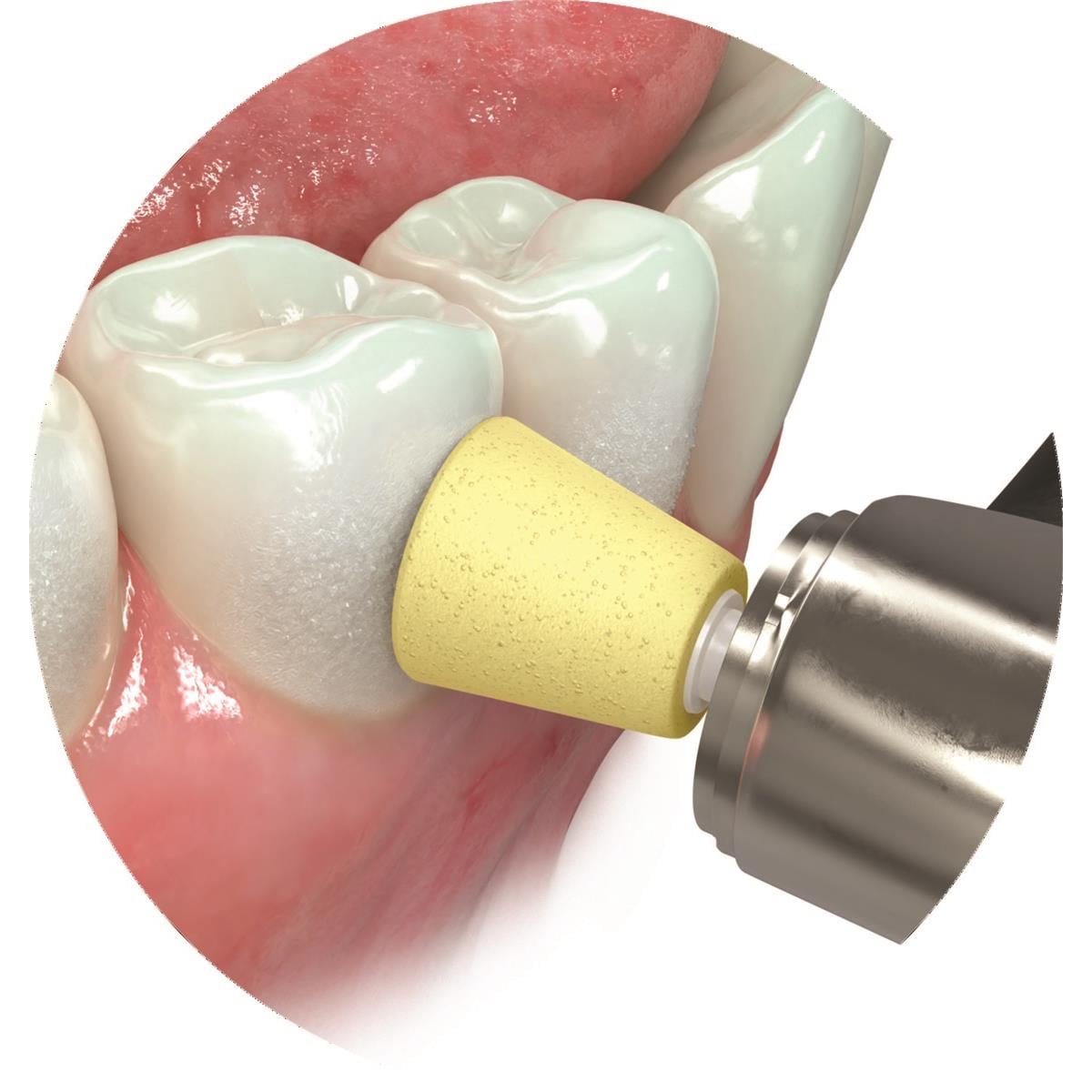JIFFY ONE CUPULES Grain Moyen (20 units) ULTRADENT