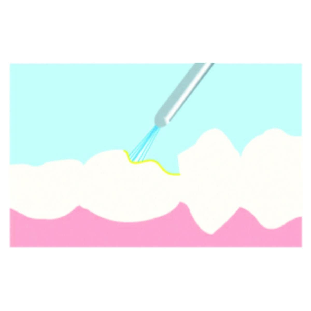 Composite Nano Hybride Natural Elegance - A3/D3 - Unidoses 0,25g - Bote de 20 - HENRY SCHEIN
