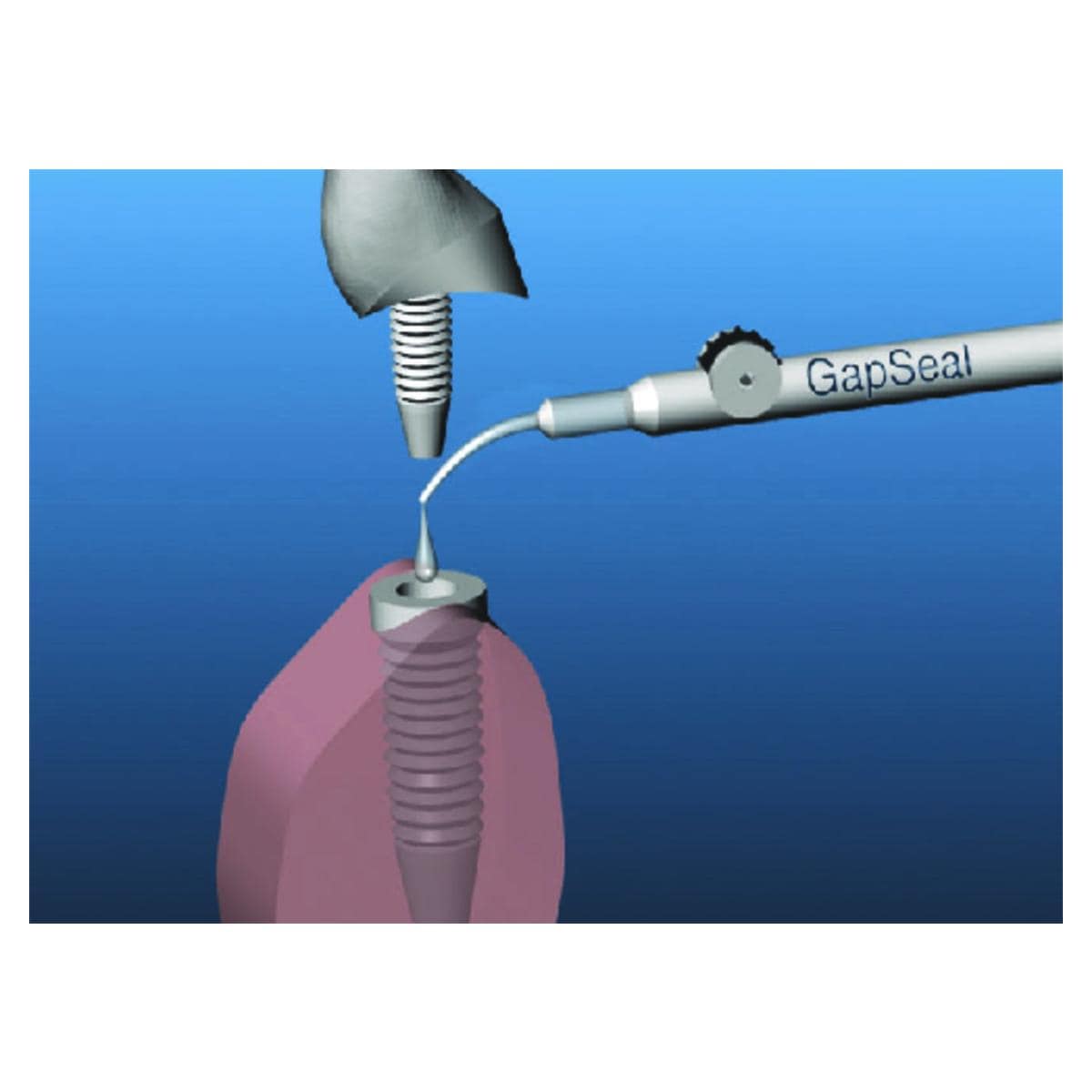 GapSeal HAGER &WERKEN - L'applicateur