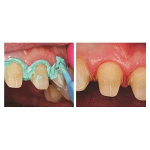Dryz BLU Pte de rtraction gingivale hmostatique unidose - 30 pices - PARKELL