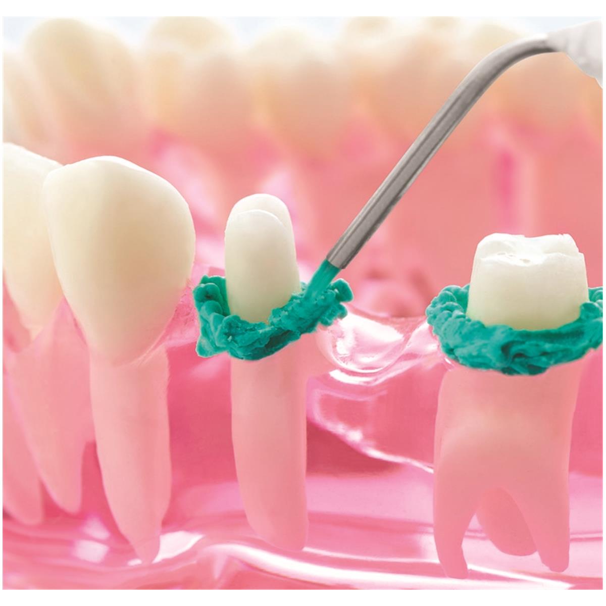 Dryz BLU Pte de rtraction gingivale hmostatique unidose - 30 pices - PARKELL