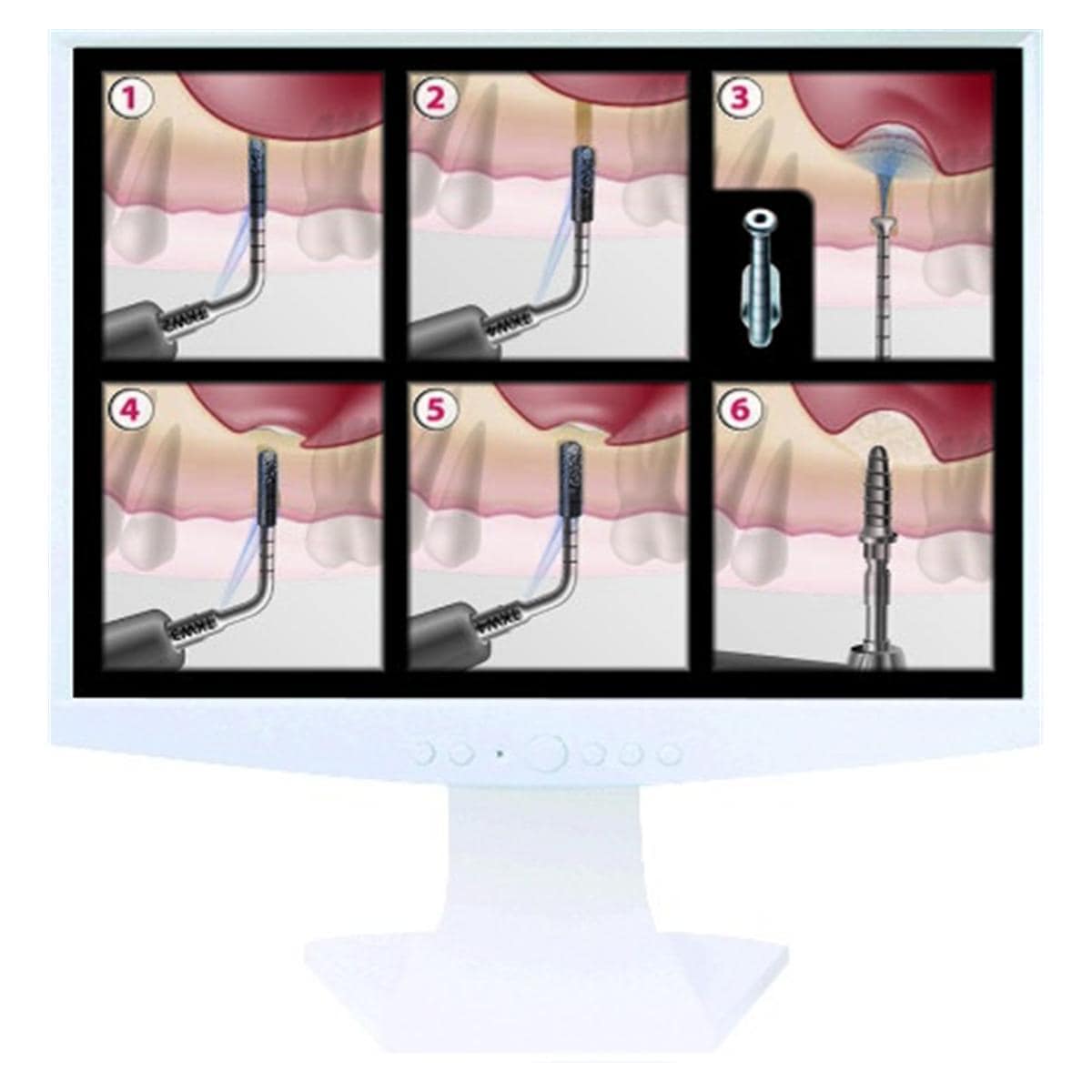 Kit Intralift 2 ACTEON SATELEC