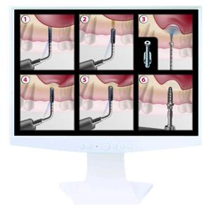 Kit Intralift 2 ACTEON SATELEC