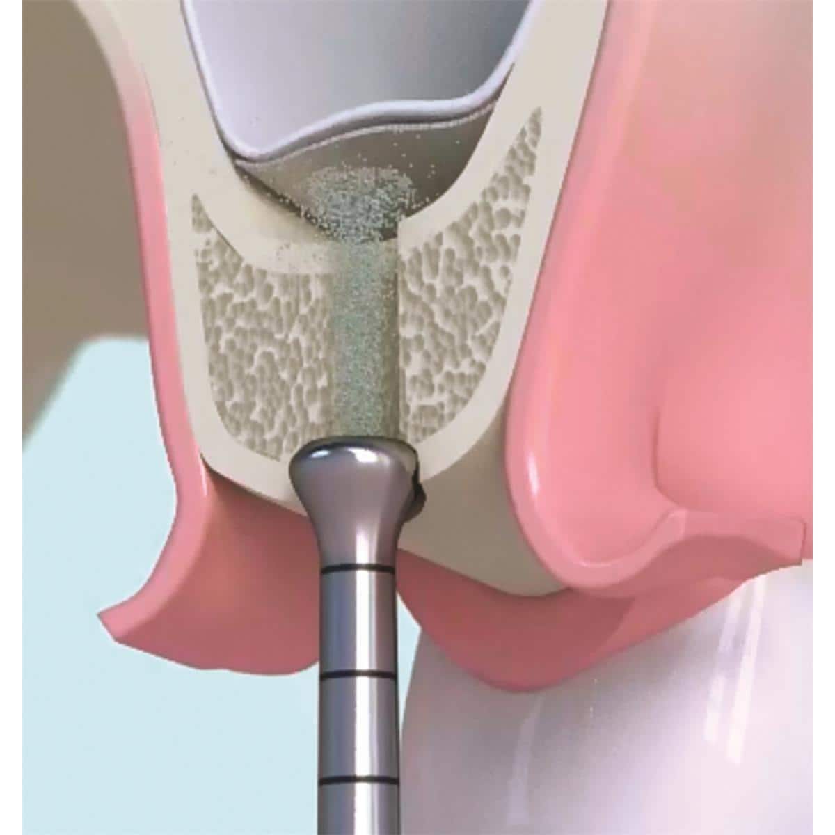 Kit Intralift 2 ACTEON SATELEC