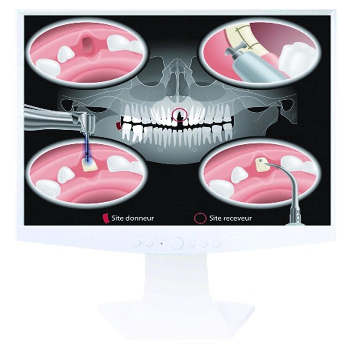 Kit Bone Surgery 2 ACTEON SATELEC