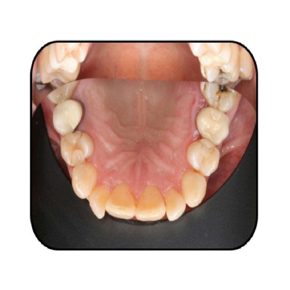 Contrastor Silicone NICHROMINOX - Suprieur troit enfant