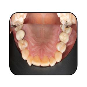 Contrastor Silicone NICHROMINOX - Suprieur troit enfant